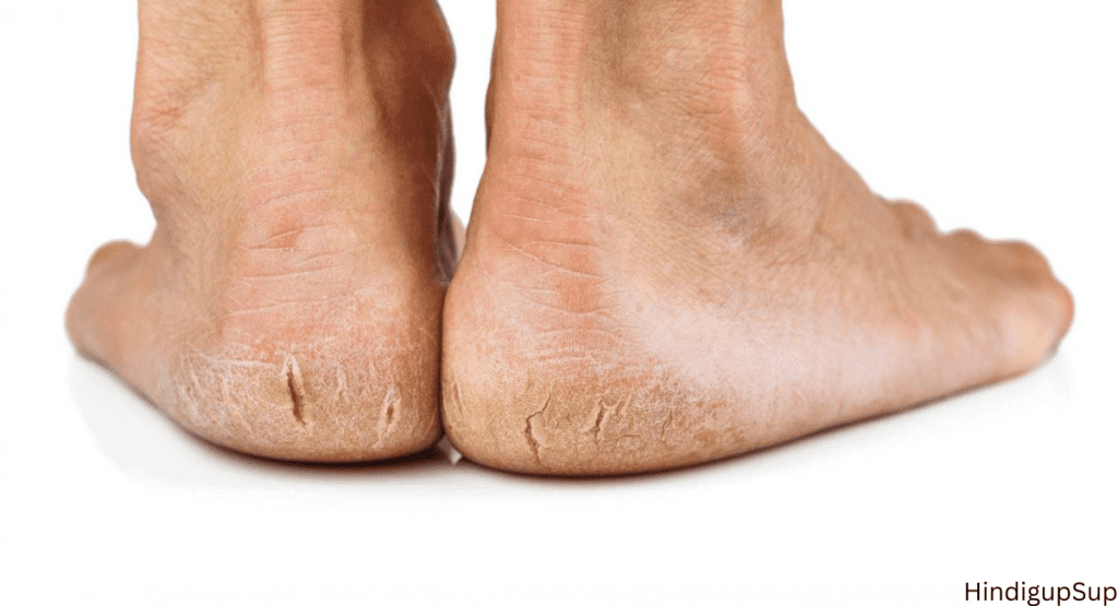 फटी एड़ियों को घर पर ही कैसे करें ठीक - How to Treat Crack Heel at Home