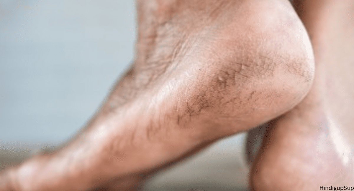 फटी एड़ियों को घर पर ही कैसे करें ठीक - How to Treat Crack Heel at Home. 