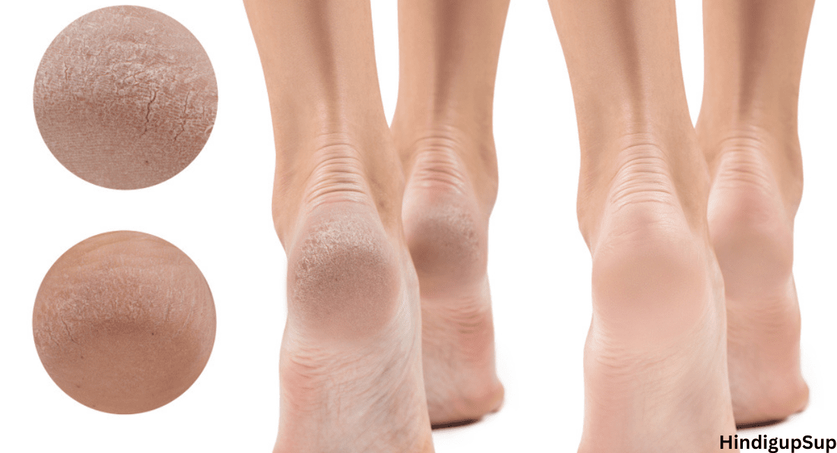 फटी एड़ियों को घर पर ही कैसे करें ठीक - How to Treat Crack Heel at Home. 