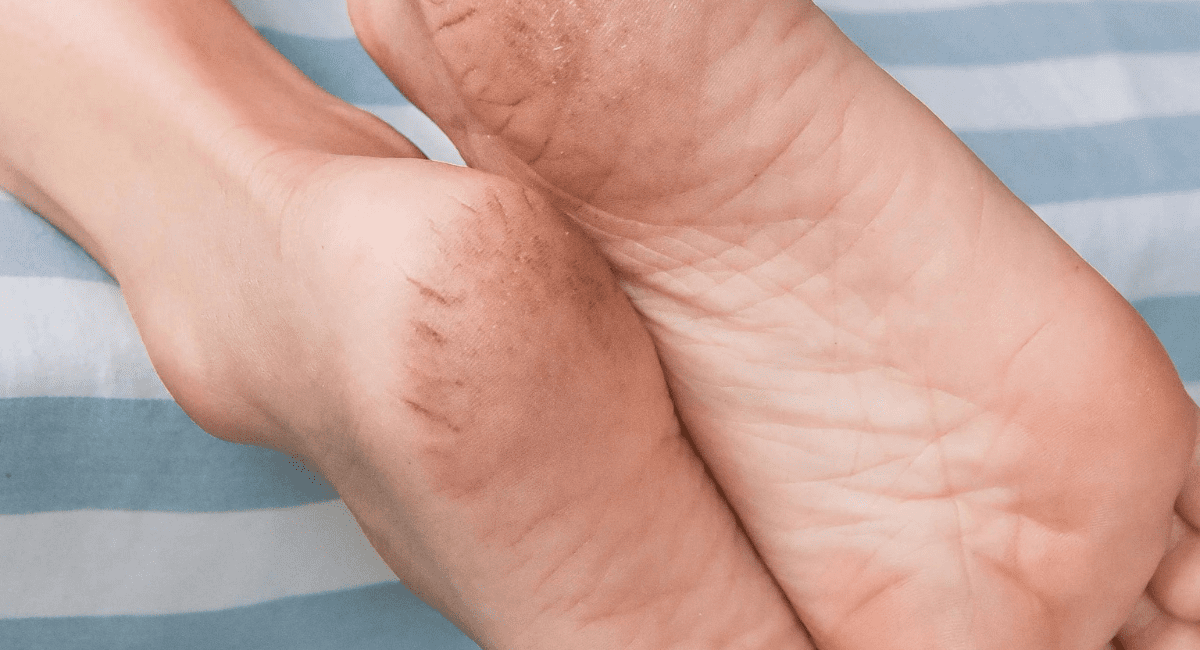 फटी एड़ियों को घर पर ही कैसे करें ठीक - How to Treat Crack Heel at Home