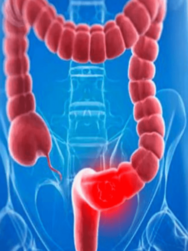 पाइल्स से बचने के घरेलू नुस्खे – Get 7 Relief from Piles