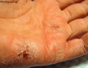 Read more about the article फटे हुए हाथो को घर पर कैसे ठीक करें – How to Treat Cracked Hands