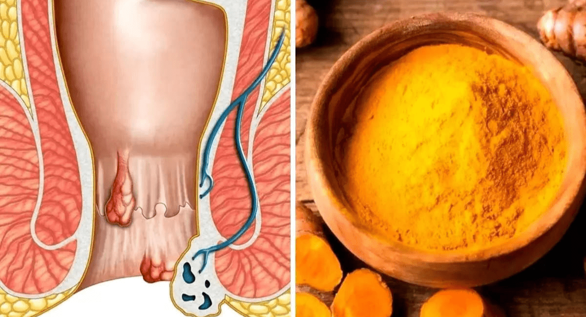 पाइल्स से छुटकारा पाने के घरेलू उपाय - 9 Home Remedies to Get Rid of Piles 2 पाइल्स से छुटकारा पाने के घरेलू उपाय - 9 Home Remedies to Get Rid of Piles