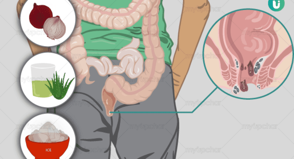 पाइल्स से छुटकारा पाने के घरेलू उपाय - 9 Home Remedies to Get Rid of Piles 9 पाइल्स से छुटकारा पाने के घरेलू उपाय - 9 Home Remedies to Get Rid of Piles