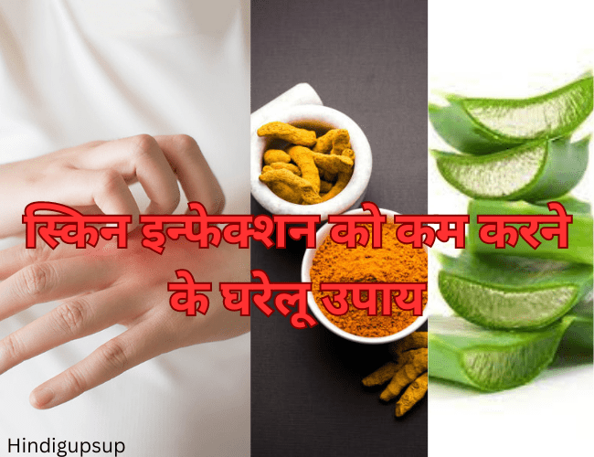 Read more about the article स्किन इन्फेक्शन को कम करने के घरेलू उपाय – How to Get Rid of Fungal Infection