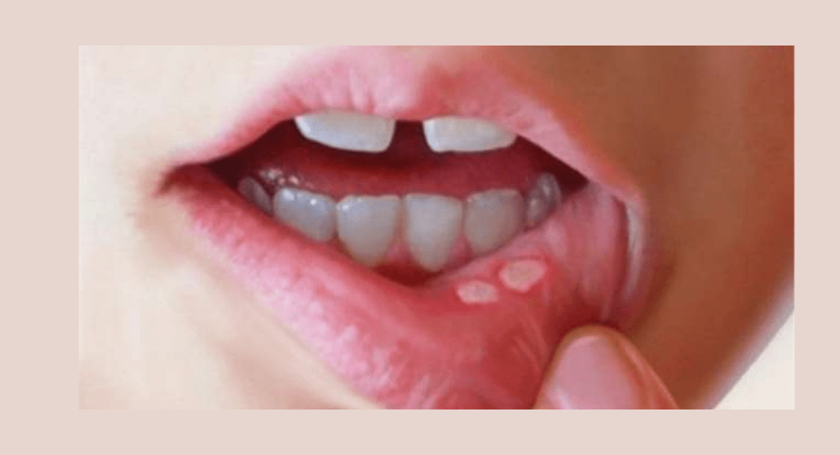 मुंह के छाले कम करने के घरेलू नुस्खे कौन से हैं - Which Home Remedies to Reduce Mouth Ulcers