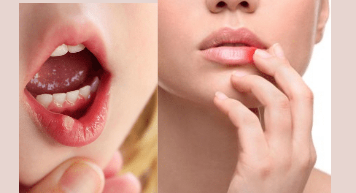 मुंह के छाले कम करने के घरेलू नुस्खे कौन से हैं - Which Home Remedies to Reduce Mouth Ulcers