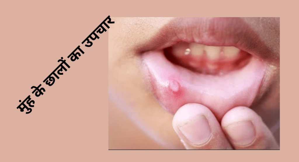 मुंह में छाले होने के कारण, मुंह के छालों का उपचार - Treatment of mouth Ulcers