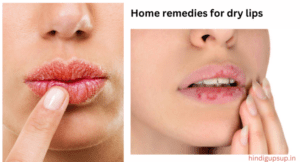 Read more about the article ड्राई होठों से परेशान है तो करें ये उपाय, सूखे होंठों के लिए घरेलू नुस्खे  – 8 Home Remedies for Dry Lips