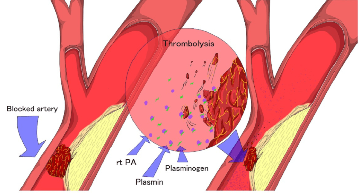 पायलट प्रोजेक्ट के जरिए थ्रोबोलिसिस करा सकेंगे मरीज - Patients will be Thrombolysis Through Pilot Project