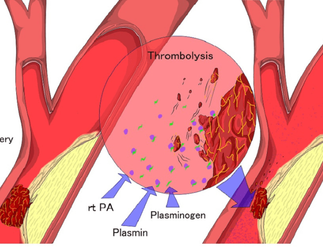 पायलट प्रोजेक्ट के जरिए थ्रोबोलिसिस करा सकेंगे मरीज - Patients will be Thrombolysis Through Pilot Project