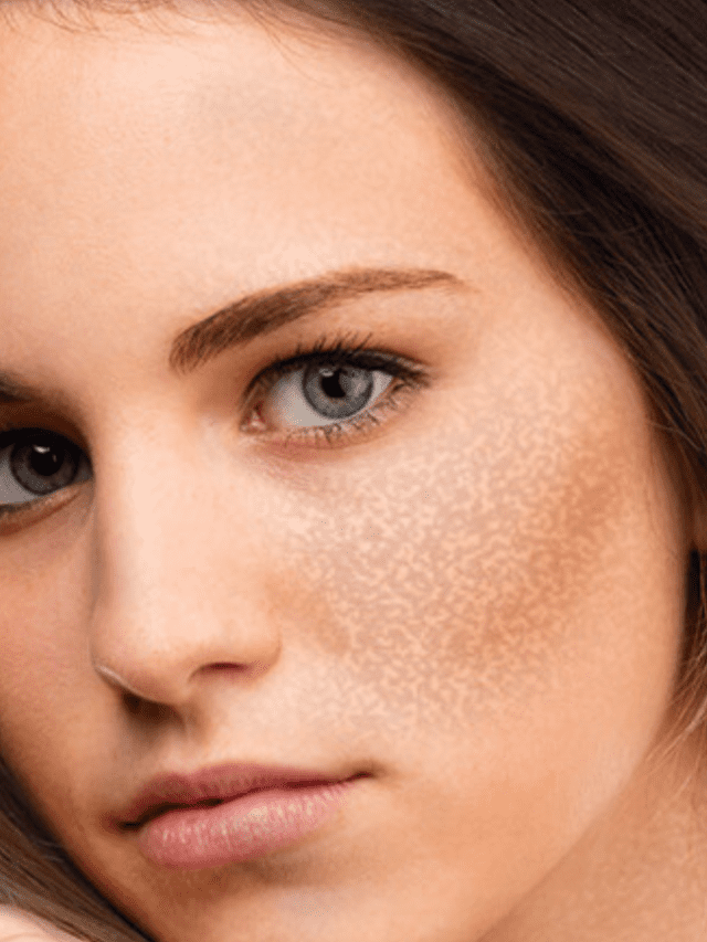 झांइयों को कम कैसे करें - Tips to Treat Pigmentation