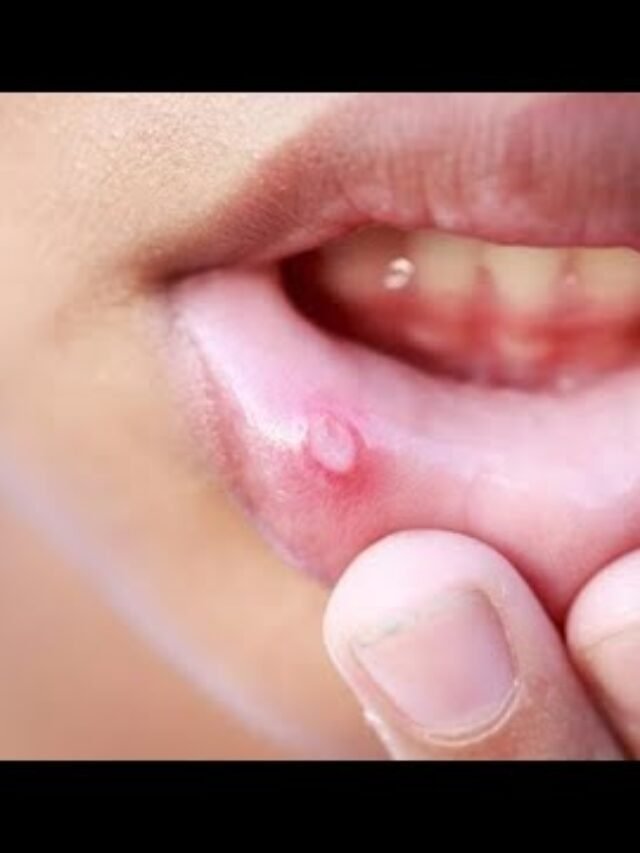 मुंह के छालों का उपचार – Treatment of mouth Ulcers